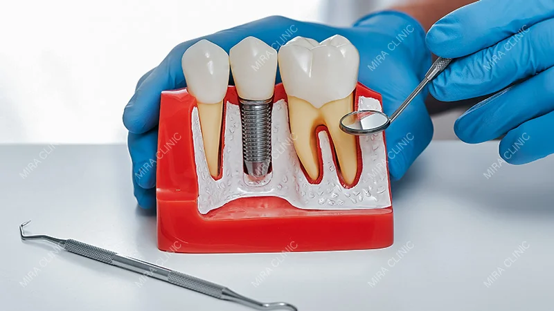 implant stability & tissue health